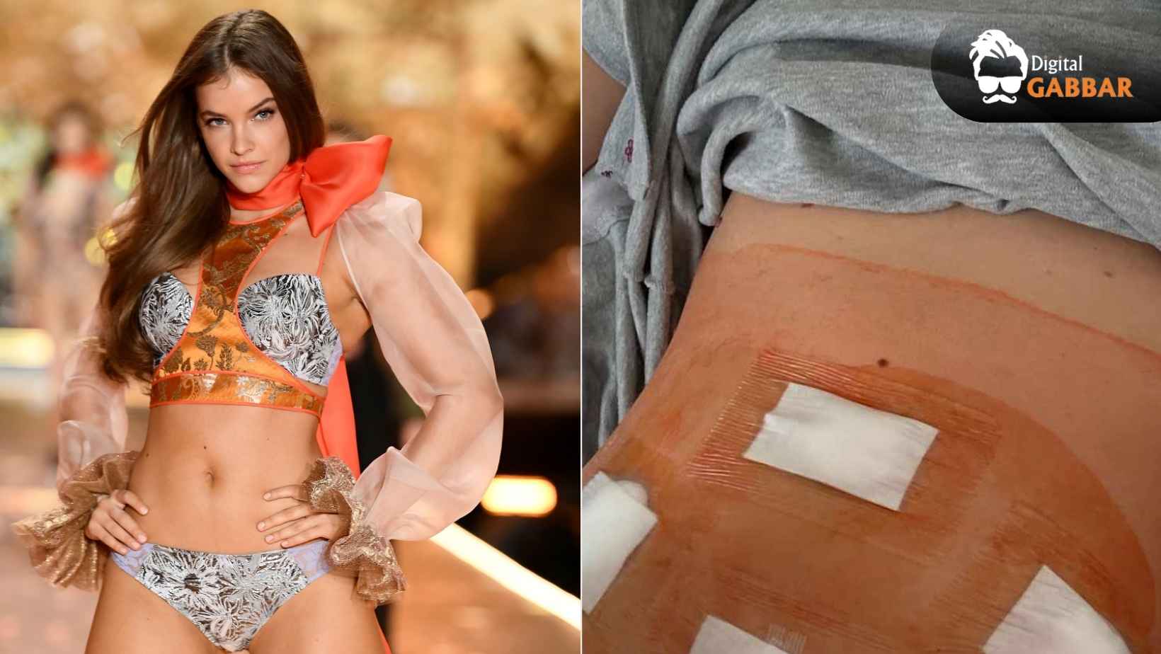 Barbara Palvin Endometriosis Diagnosis Surgery Recovery